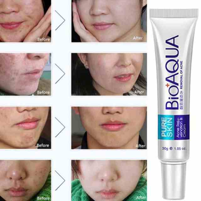 BioAqia Acne Removal Pure Skin Cream - 30g