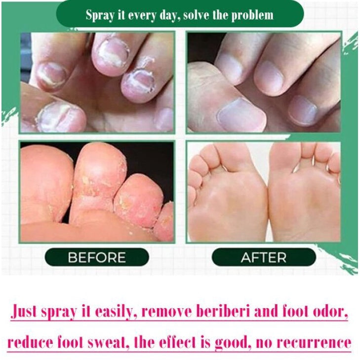 Anti-Nail Fungus Treatment