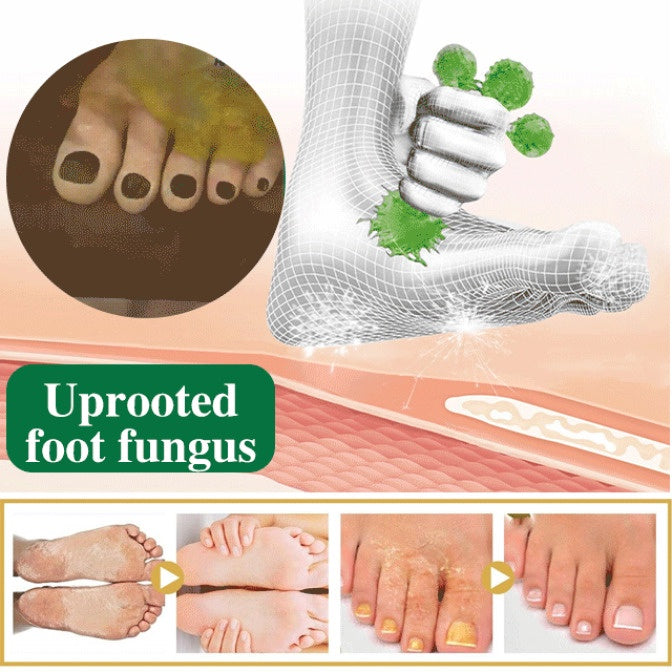 Anti-Nail Fungus Treatment